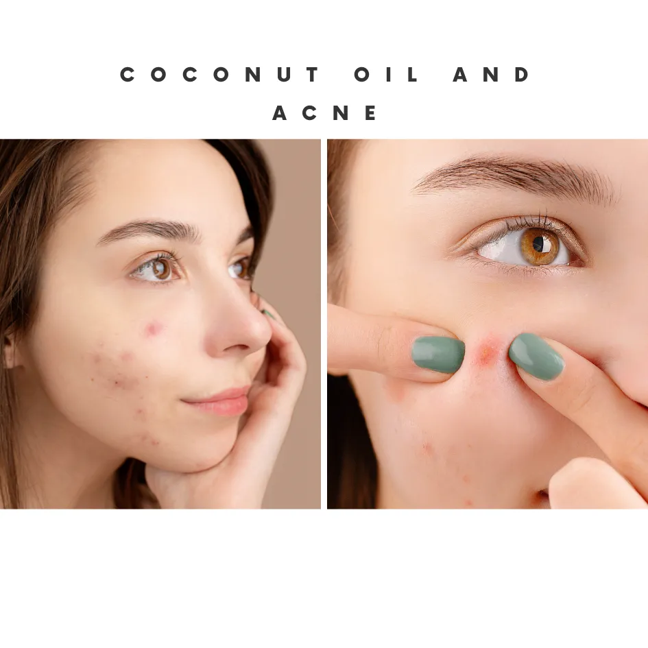 Coconut Oil and Acne
